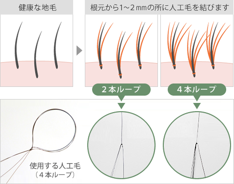 結んで増やす特許増毛法